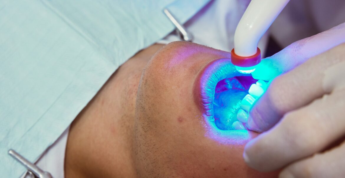 Why Teeth Whitening Is the Most Popular